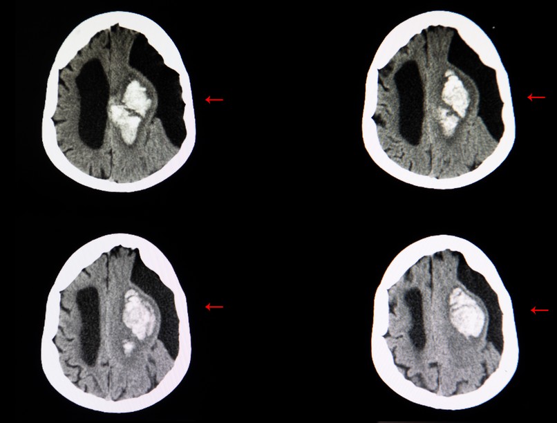 Subarachnoideális ciszta