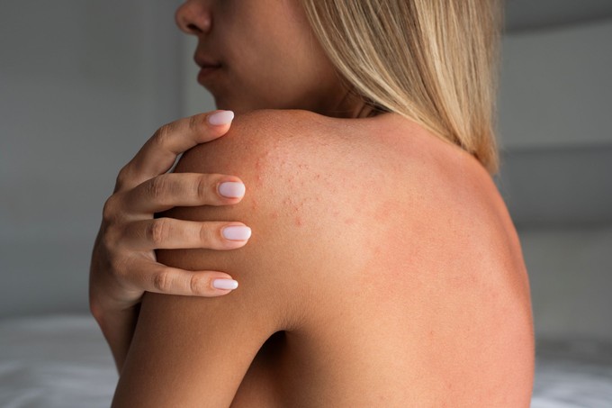 Ez a kellemetlen allergia az egész nyaralást tönkreteheti – amint jelentkezik árnyékba kell húzódni! című cikk nyitóképe