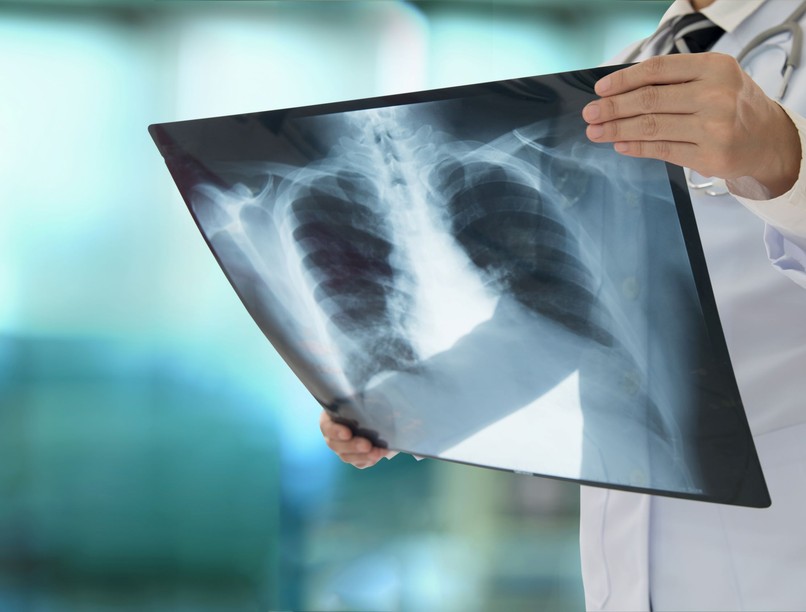 légszomj, nehézlégzés, mellkasi fájdalom, tüdőgyulladás