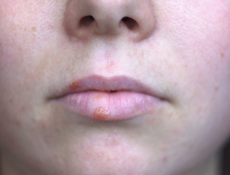 Ajakherpesz genitális herpesz oka