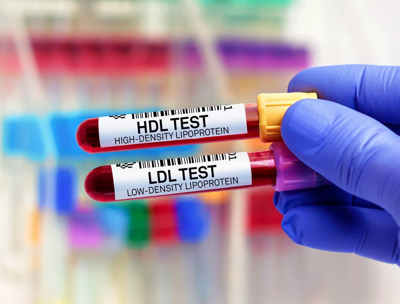 Mi számít magas koleszterinszintnek