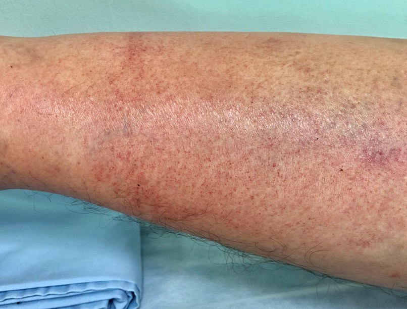 itp, folt, bőr, alacsony vérlemezkeszám