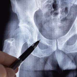 Mit tehetünk idősebb korban, hogy ne törjenek olyan könnyen a csontok? című cikk nyitóképe