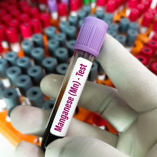 Mangánhiány tünetei, vizsgálata és kezelési lehetőségei című cikk nyitóképe