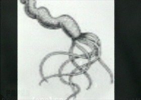 Az érelmeszesedés hátterében baktériumok állnak?