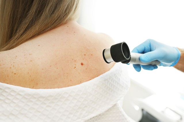 Melanoma felismerése: az új anyajegy vagy a megváltozott anyajegy a nagyobb veszély?