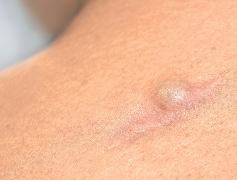 pattanás, rarpofa farokcsont pilonidális ciszta tünet