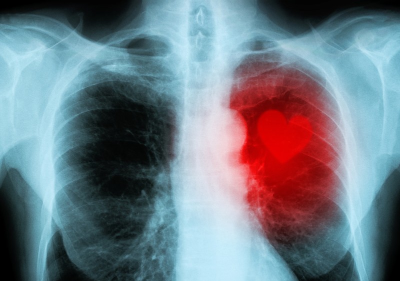 Ez történt a gyermekekkel, akiknél a covid-oltás szívizomgyulladást okozott