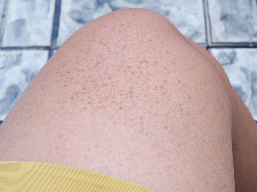 A keratosis pilaris gyakoribb, mint gondolnánk, ugyanis az emberek 40%-át érinti, sőt fiataloknál akár 60-80%-ban is előfordul. Ilyenkor jellegzetes apró, bőrszínű vagy rózsaszín, tapintásra gyakran dörzspapírra emlékeztető dudorok jelennek meg az érintettek felkarján, combján, esetleg arcán.