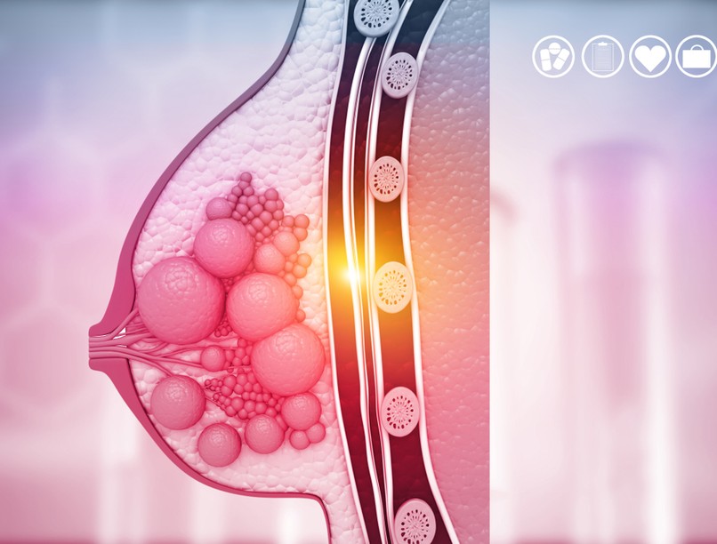 mellrák, emlőrák, emlődaganat, gyulladásos mellrák, tünetei, kezelése
