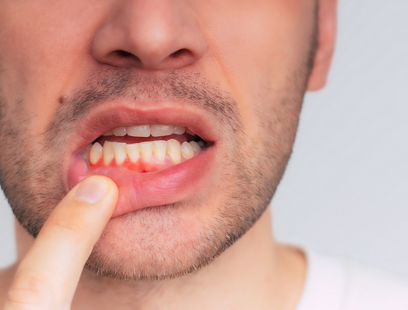 diabétesz cukorbetegség jele fog íny