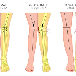 Angolkór, csontlágyulás: tünetei, vizsgálata és kezelési lehetőségei című cikk nyitóképe