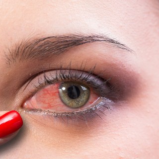 Viszket, éget, szúr a szeme? Ha kötőhártya-gyulladást kapott, nem mindegy, mivel borogatja című cikk nyitóképe