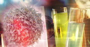 CAR-T-sejt terápia: így működik a vérrákos betegek reménysugara! Betegtapasztalat videóval