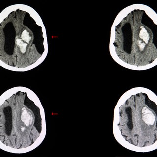 Subarachnoideális ciszta című cikk nyitóképe