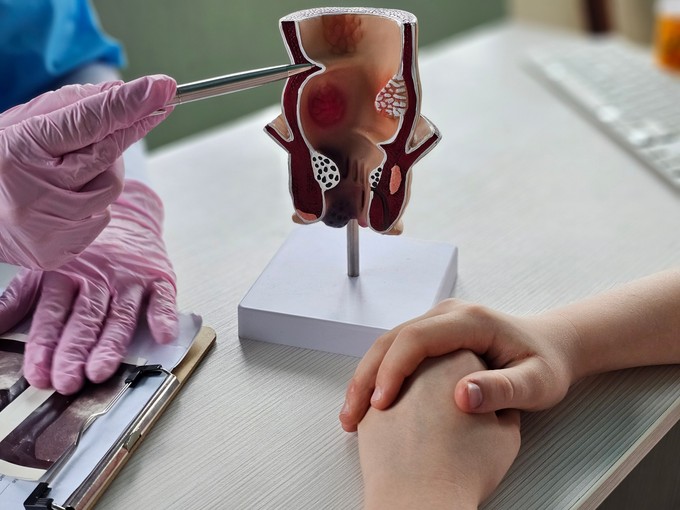 Különös módon emlékeztet a hibáinkra az aranyér: ezt teheti, hogy ne újuljon ki többet című cikk nyitóképe