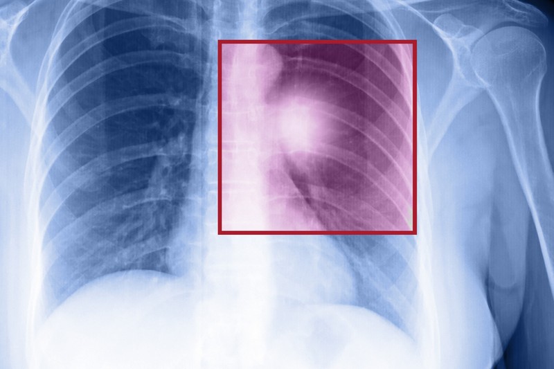 Rosszindulatú tüdődaganat: ezekkel a vizsgálatokkal mutatható ki a legjobban