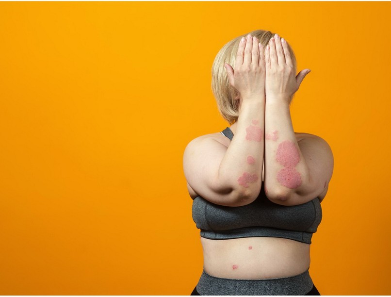 pikkelysomor, viszketes étrend száraz bőr