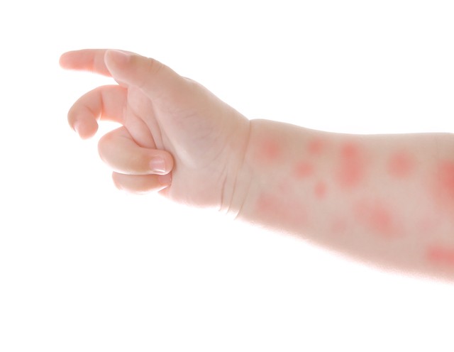 Kanyarójárvány Kelet-Szlovákiában: egyre többen betegek