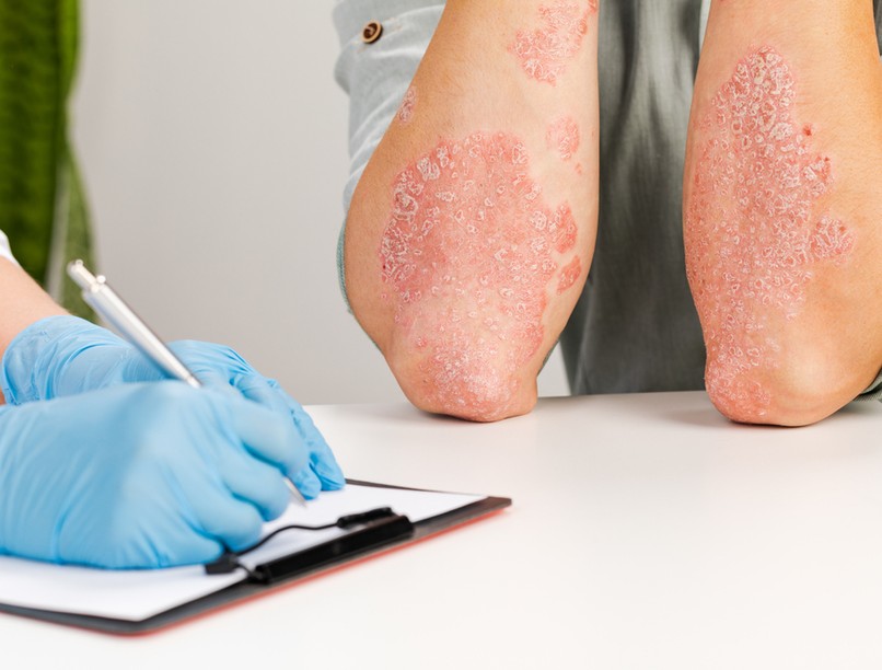 pikkelysömör, pszoriázis, kezelése, terápia, gyulladásos, beetgség, bőrbetegség