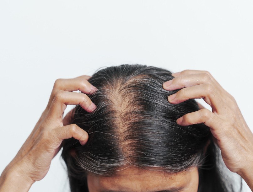 foltos hajhullás ellen hajvesztés ok