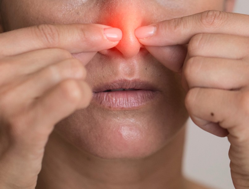 orrsövényferdülés, orrszárazság, orrdugulás, orrspray