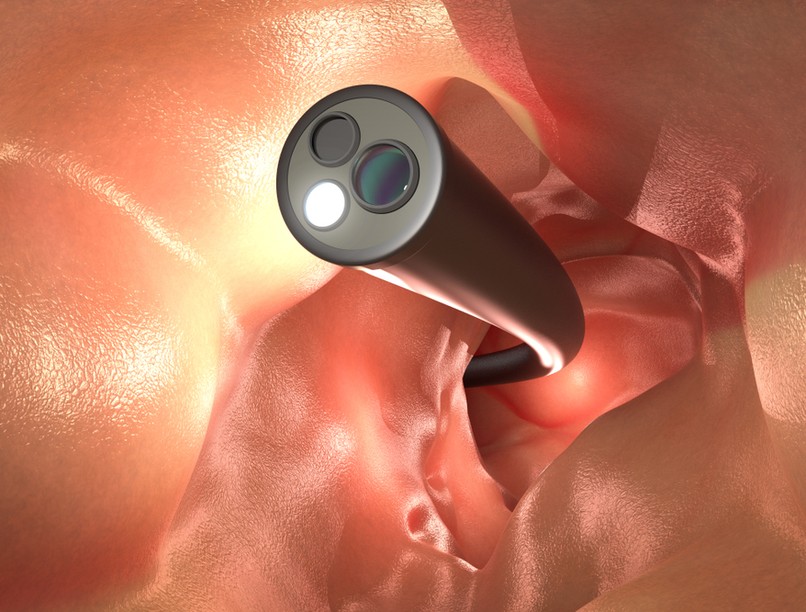  vastagbéltükrözés, kolonoszkópia, vizsgálat, étkezés, rákos betegség