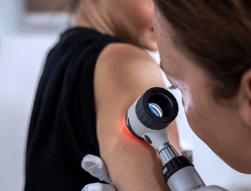anyajegyszűrés melanoma bőrrák jelei bőrgyógyász