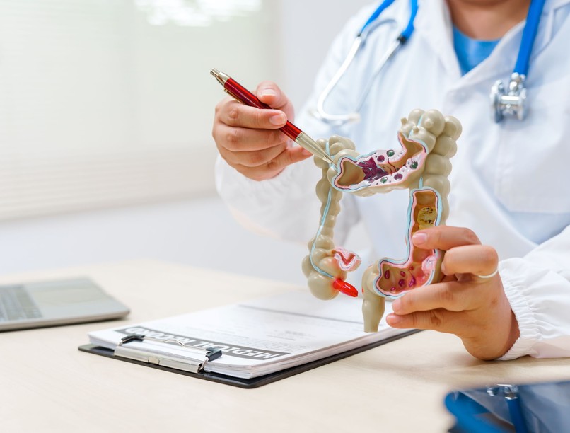 vastagbélrák kezelés stádium hogyan