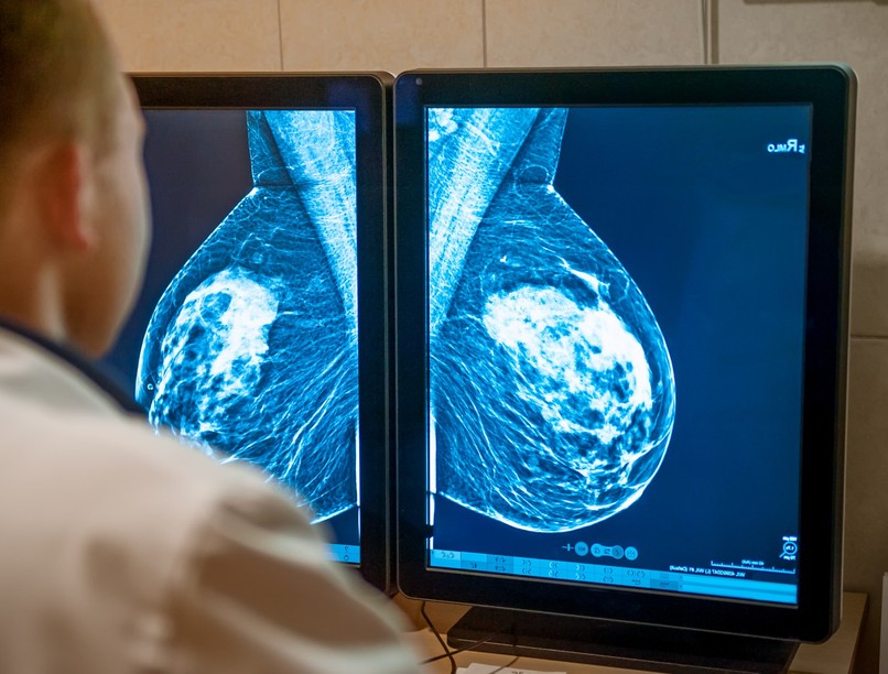 emlőrák, kutatás, magyar, rák