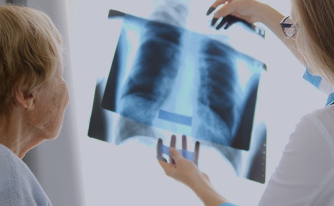 Magyarországon a tüdőrák áldozatainak száma, hasonlóan a nemzetközi adatokhoz az egyik legmagasabb a daganatos betegségek között.