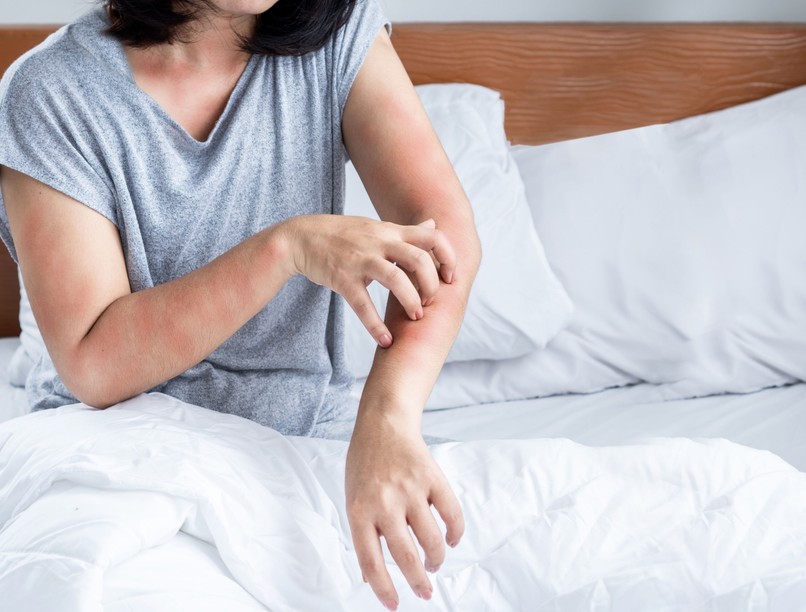 ágyi poloska csípés mit tegyek