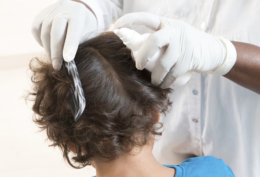 A fejtetű kellemetlen, de nagyon gyakori probléma, a legtöbbször a gyerekeket érinti. Melyik módszer a legjobb tetvek ellen?