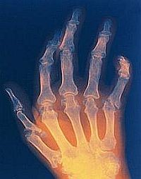 Artritisz (az ízületek gyulladásos megbetegedése)