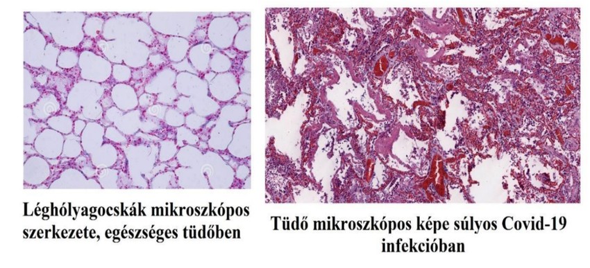 Egészséges, és koronavírussal fertőzött léghólygocskák szerkezete.
