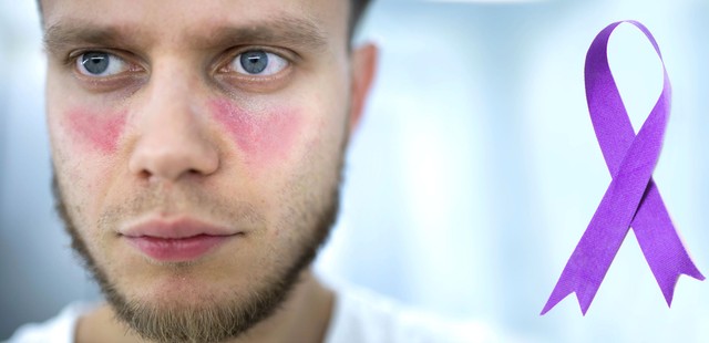 A lupus első jelei: ezeket a tüneteket sokan hónapokig figyelmen kívül hagyják