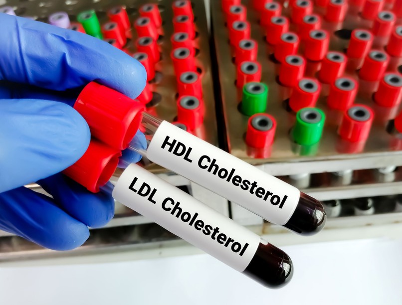 összkoleszterion Mennyi idő alatt csökken a koleszterinszint