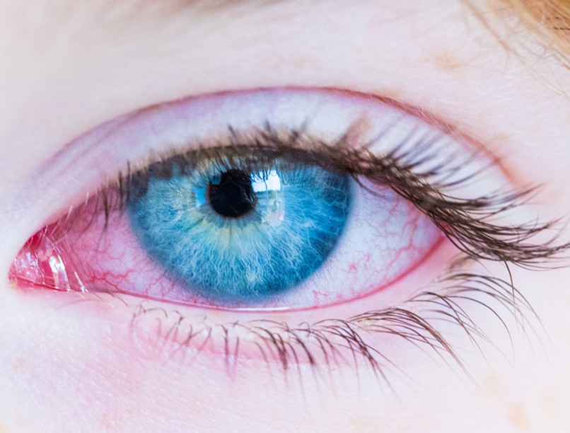 koronavírus tünet, szemfertőzés, kötőhártya-gyulladás, covid-19