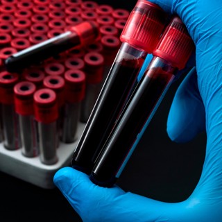 Mit jelent a Vörösvértest-süllyedés érték a laborleleten? című cikk nyitóképe