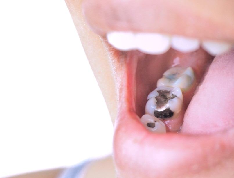 amalgam, fogtömés, higany, fog