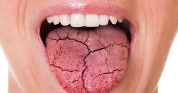  Szájszárazság: kiváltó oka, tünetei és kezelési lehetőségei 
