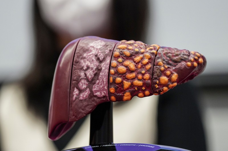 Májrák és májáttétek: ezt kell tudni a kialakulásukról