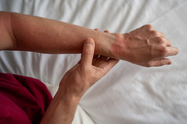 Napallergia: ezt teheti, ha a bőre nem bírja a napfényt!