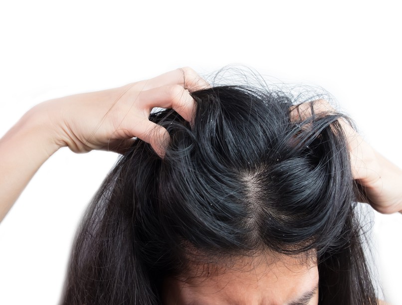 korpás haj, viszketés