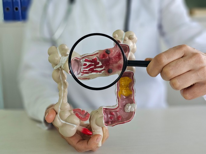 A túl kevés, de a túl sok vas is megnövelheti a vastagbélrák esélyét című cikk nyitóképe