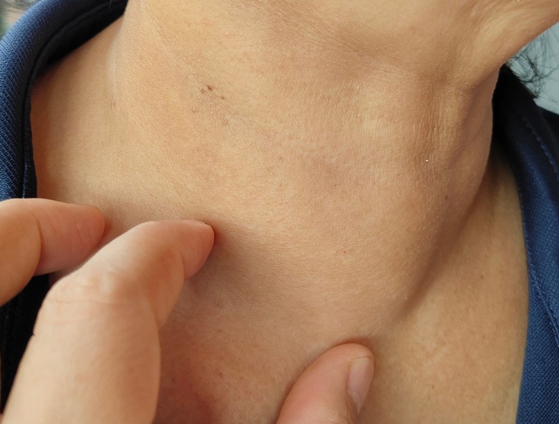 pajzsmirigy betegség kezelés hormon gyógyszer műtét