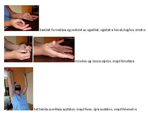 Parkinson-kór gyógytorna kezelése (3. rész)