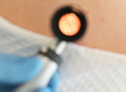 Ezért fontos télen ellenőrizni magunkon az anyajegyeket: 5 jel, ami melanómára utalhat című cikk nyitóképe