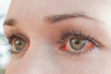 Kipirosodott szem, szemfájdalom - ezek is szerepelnek a zöldhályog korai tünetei közt