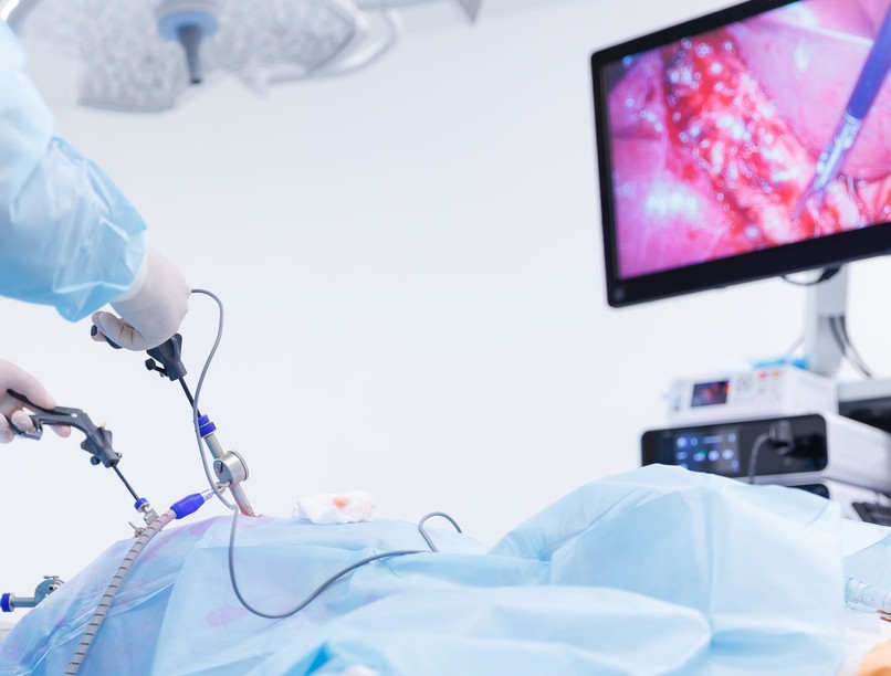 laparoszkópia, műtét, invazív eljárás, sebészet